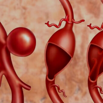 Arterial Aneurysm Enlarged Arteries