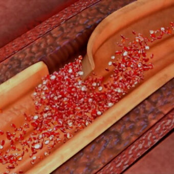 Arterial Dissection Tear In The Artery