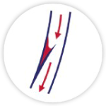 Arterial Dissection