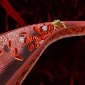 Arterial Thrombosis Clot In The Artery