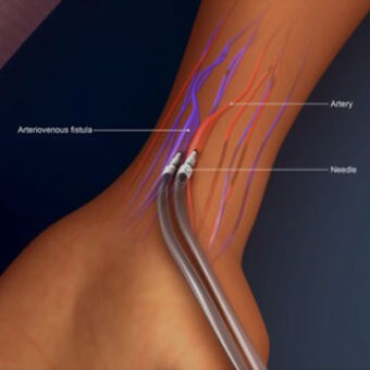 Dialysis Access Surgery