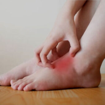 Leg Swelling discomfort