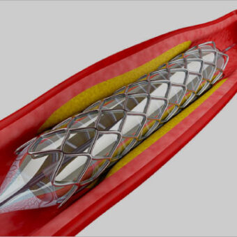 Minimally Invasive Endovascular Surgery