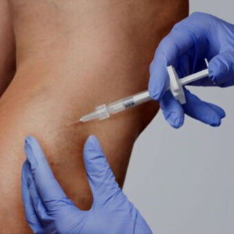 Spider Veins Treatment