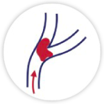 Stroke Mini Stroke Transient Ischaemic Attack
