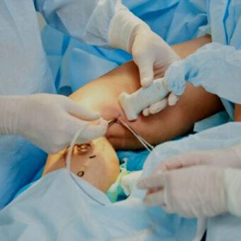 Varicose Vein Treatment