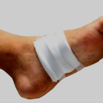 ulcers