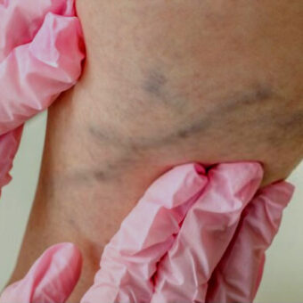 Varicose Veins