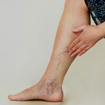 visible veins