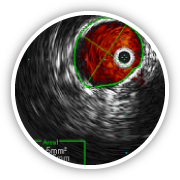 complex venous surgery