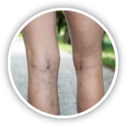 varicose vein surgery
